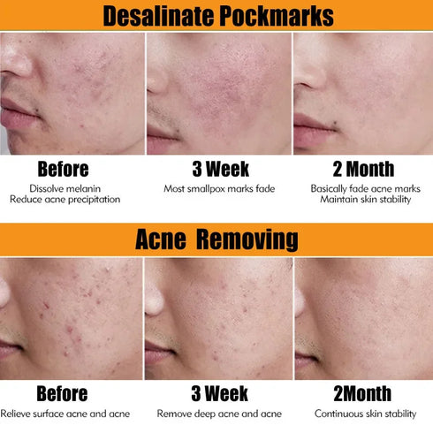 TEA TREE - Serum Acne Removal